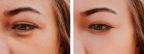 Cernes et fatigue : solutions pour un regard frais