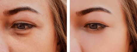 Peeling contour des yeux : adieu les cernes tenaces ?