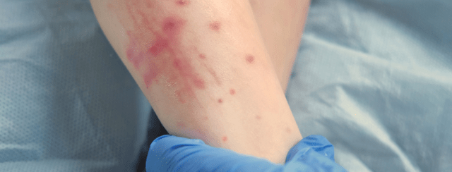 Peau atopique : causes, symptômes et solutions pour apaiser durablement