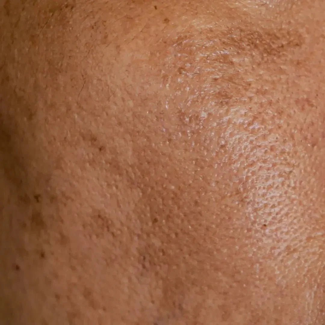 Guide complet pour éliminer les taches brunes du visage : causes, solutions et prévention