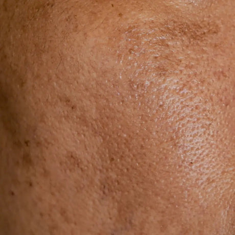 Guide complet pour éliminer les taches brunes du visage : causes, solutions et prévention