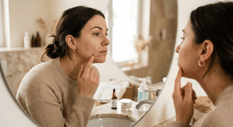 Acné adulte : pourquoi des boutons après 25 ans et que faire