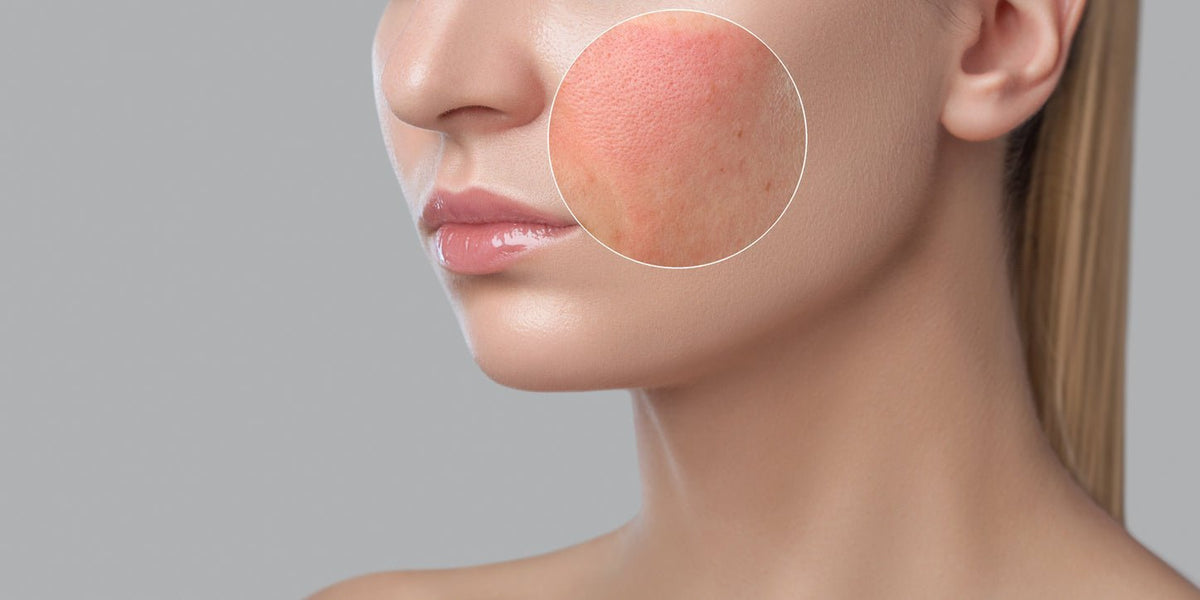 Peau apaisée et réhydratée après un peeling ou une exfoliation