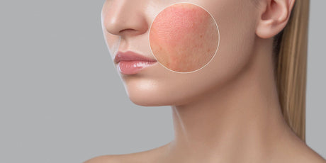 Peau apaisée et réhydratée après un peeling ou une exfoliation