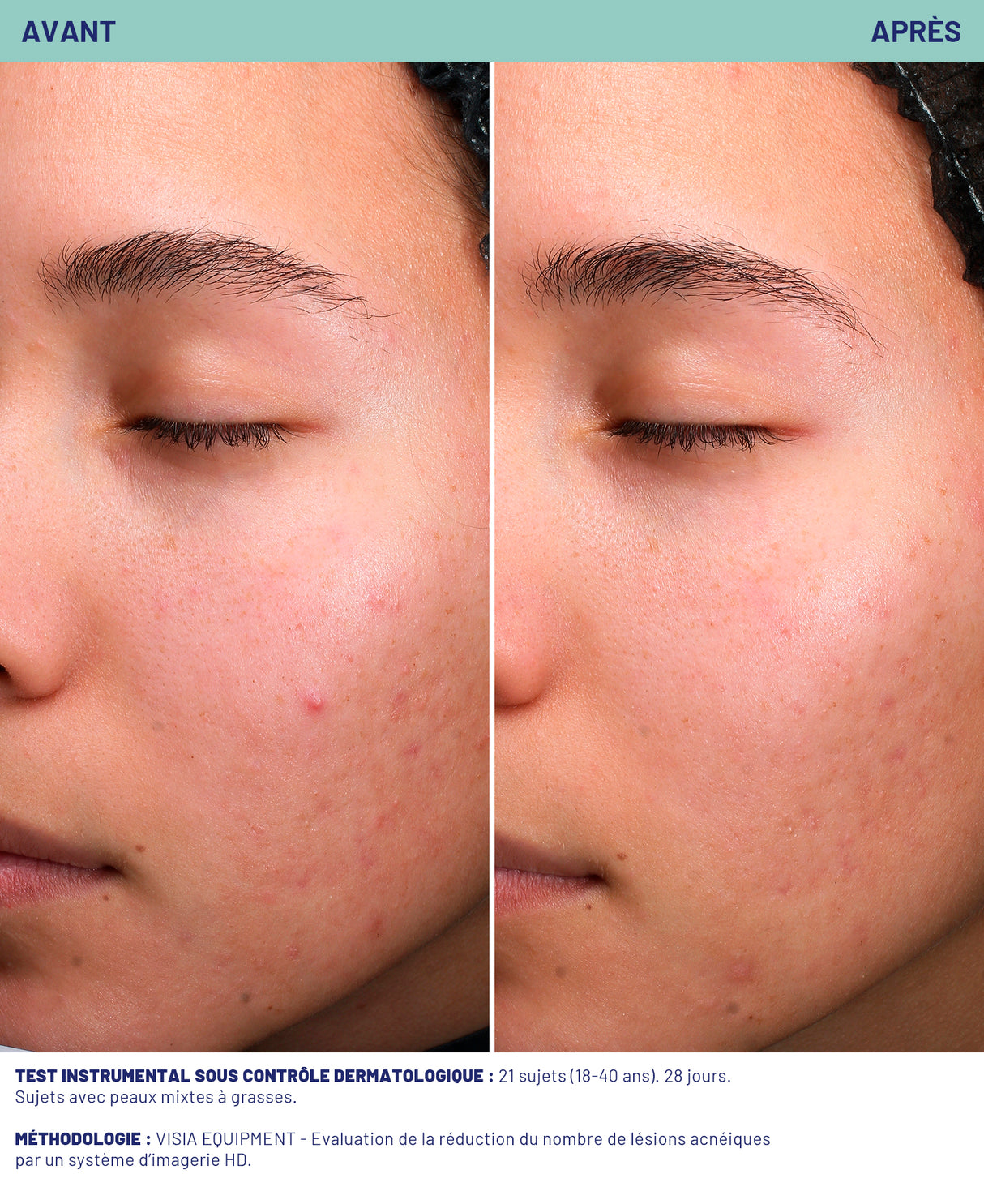 Sérum stop imperfections