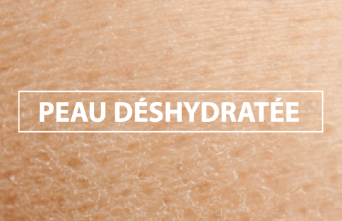 Image d'une peau déshydratée 